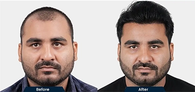 Hair Transplant in Bengaluru Before and After