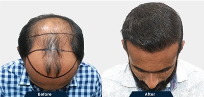 Natural Beard Transplant Results