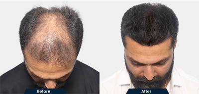 DHI Hair Transplant Before and After