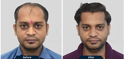 Hair Restoration Near Bengaluru