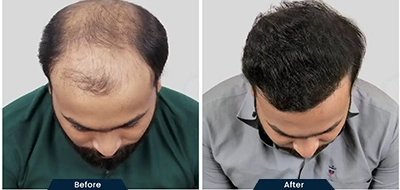 Hair Growth with Minoxidil Results