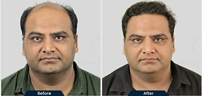 Beard Transplant in Bengaluru