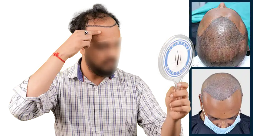 Biswal Dipu DHI Hair Transplant