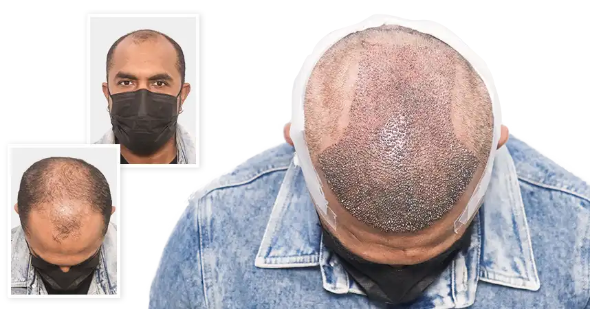 Sai Yogendra Natural Hair Restoration